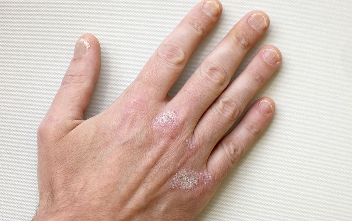 What is psoriasis pictures