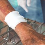 Blood clot in arm pictures