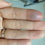 Blood clot in finger symptoms pictures