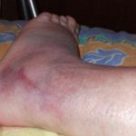 Blood clot in foot images