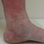 Blood clot in foot symptoms pictures