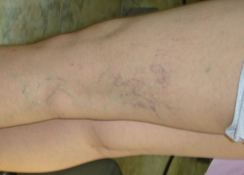 Blood Clot In Thigh Symptoms Pictures Symptoms And Pictures