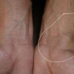 Blood clot in wrist symptoms pictures