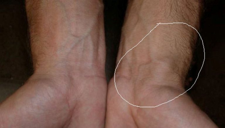 Blood Clot In Wrist Symptoms Pictures Symptoms And Pictures