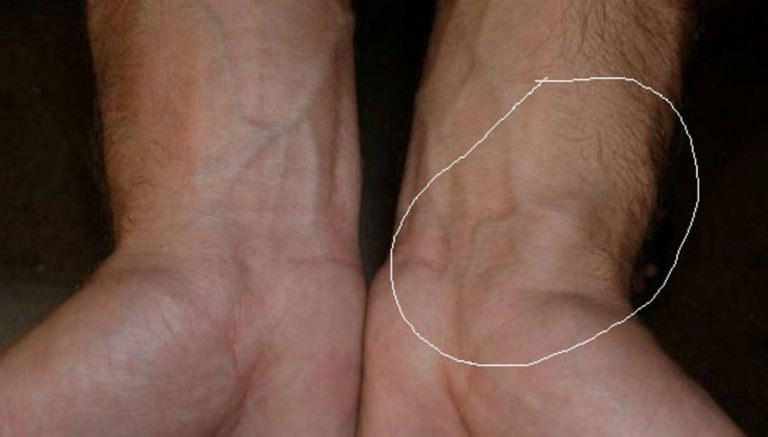 blood-clot-in-wrist-symptoms-pictures-symptoms-and-pictures