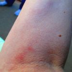 Blood clot on skin symptoms pictures