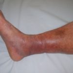 clot waffle on foot