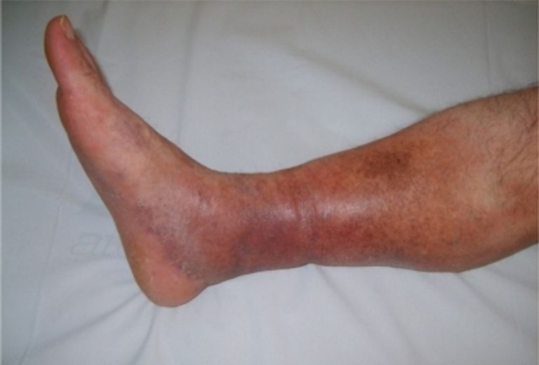 clot waffle on foot