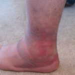 Blood clots in feet pictures