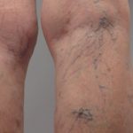 Bulging veins in legs pictures