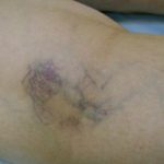 Burst vein in leg pictures