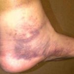 clot waffle on foot