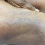 Sclerotherapy bruising photos