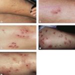 Sclerotherapy complications pictures