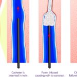 Sclerotherapy pictures