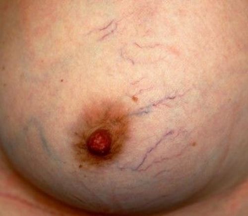 Spider veins on chest pictures