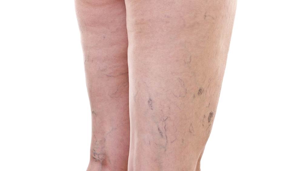 Spider veins on legs pictures