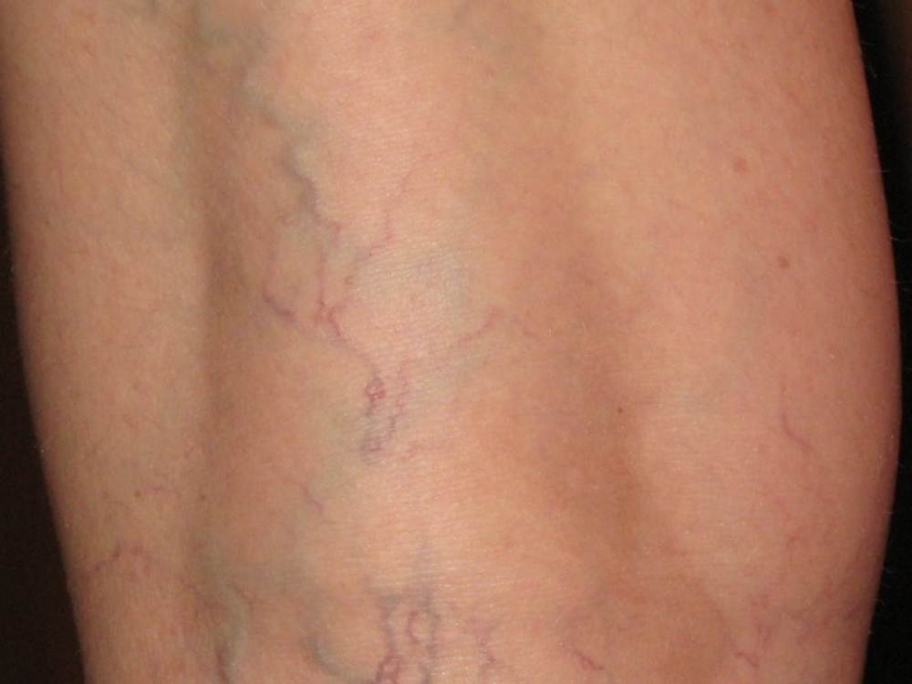 Spider veins pictures