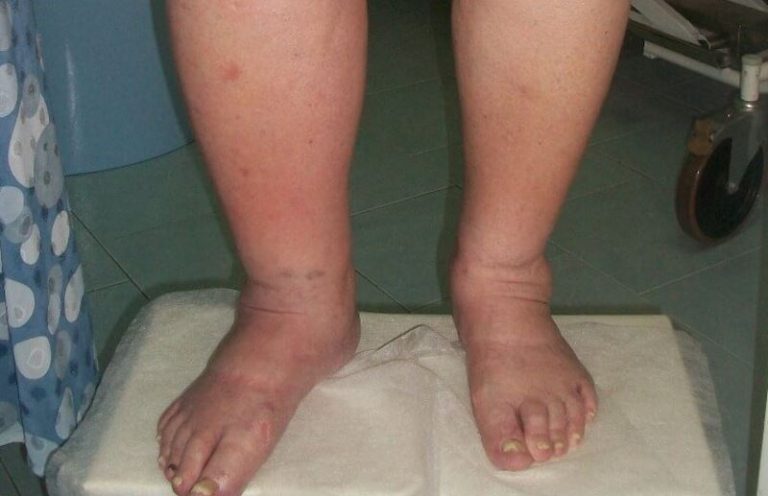 clot waffle on foot