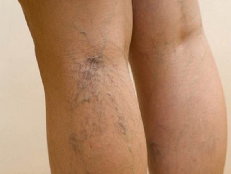 Vein disease pictures