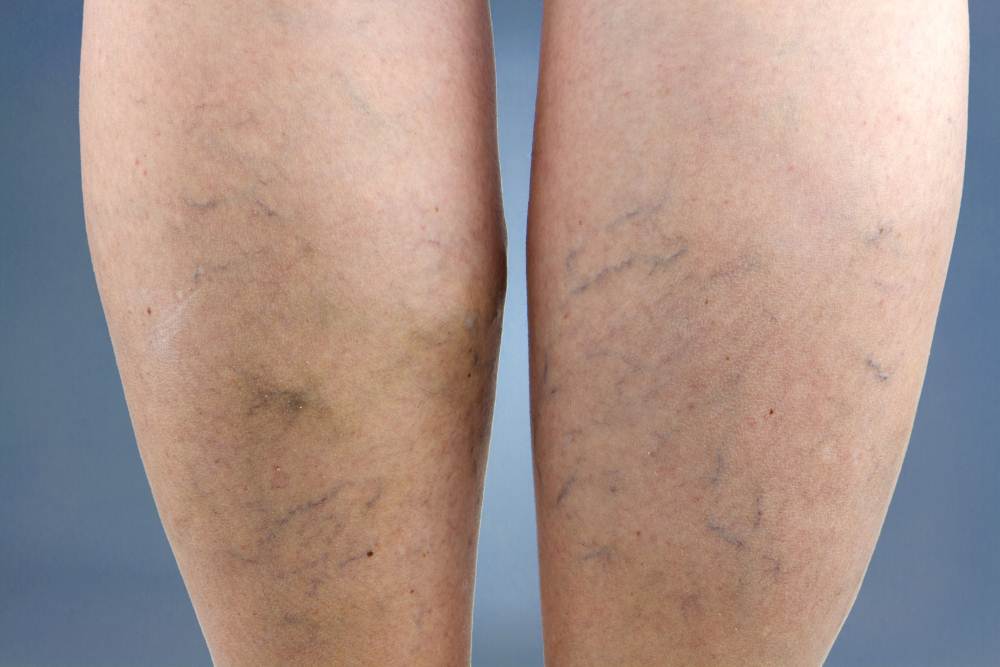 Vein disease symptoms pictures