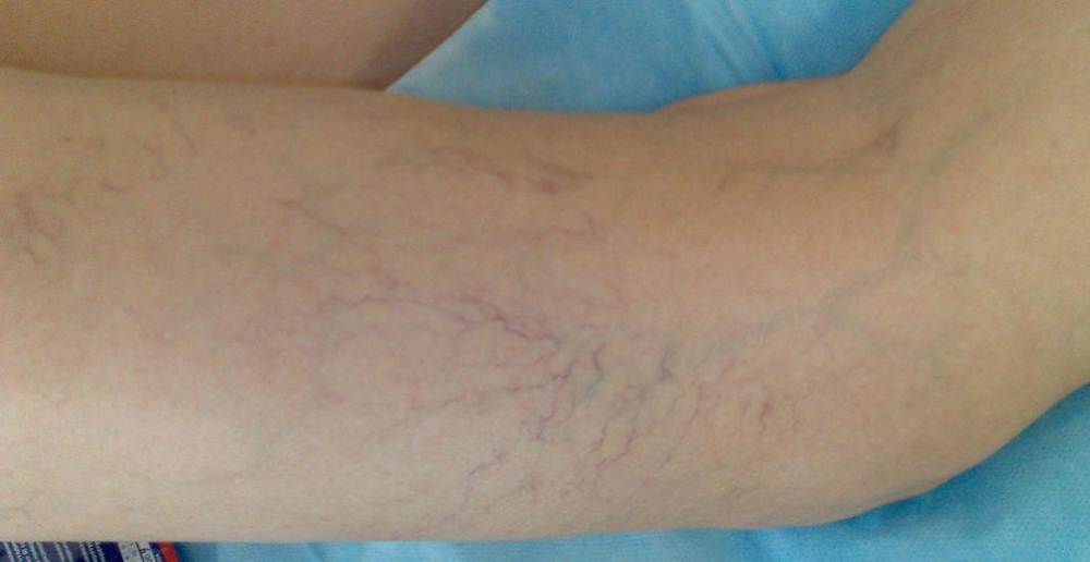 What do spider veins look like