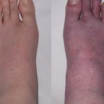 Blood pooling in feet pictures