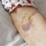 Broken blood vessel in arm pictures