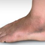 Broken blood vessel in foot pictures