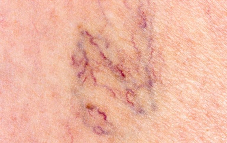 Broken Capillaries On Legs Pictures Symptoms And Pictures 6838