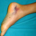Burst blood vessel in foot symptoms pictures