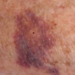Burst blood vessel in leg symptoms pictures
