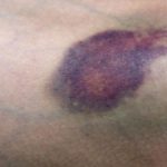 Busted blood vessel in leg pictures