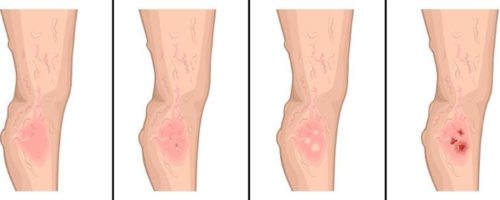 venous-leg-ulcer-pictures-venous-skin-ulcer-pictures-leg-sores