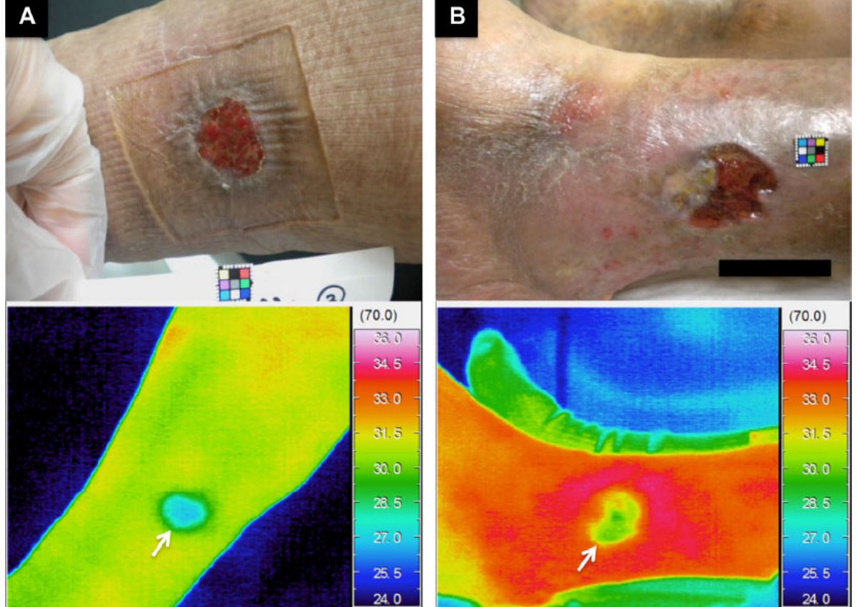 Pics of leg ulcers