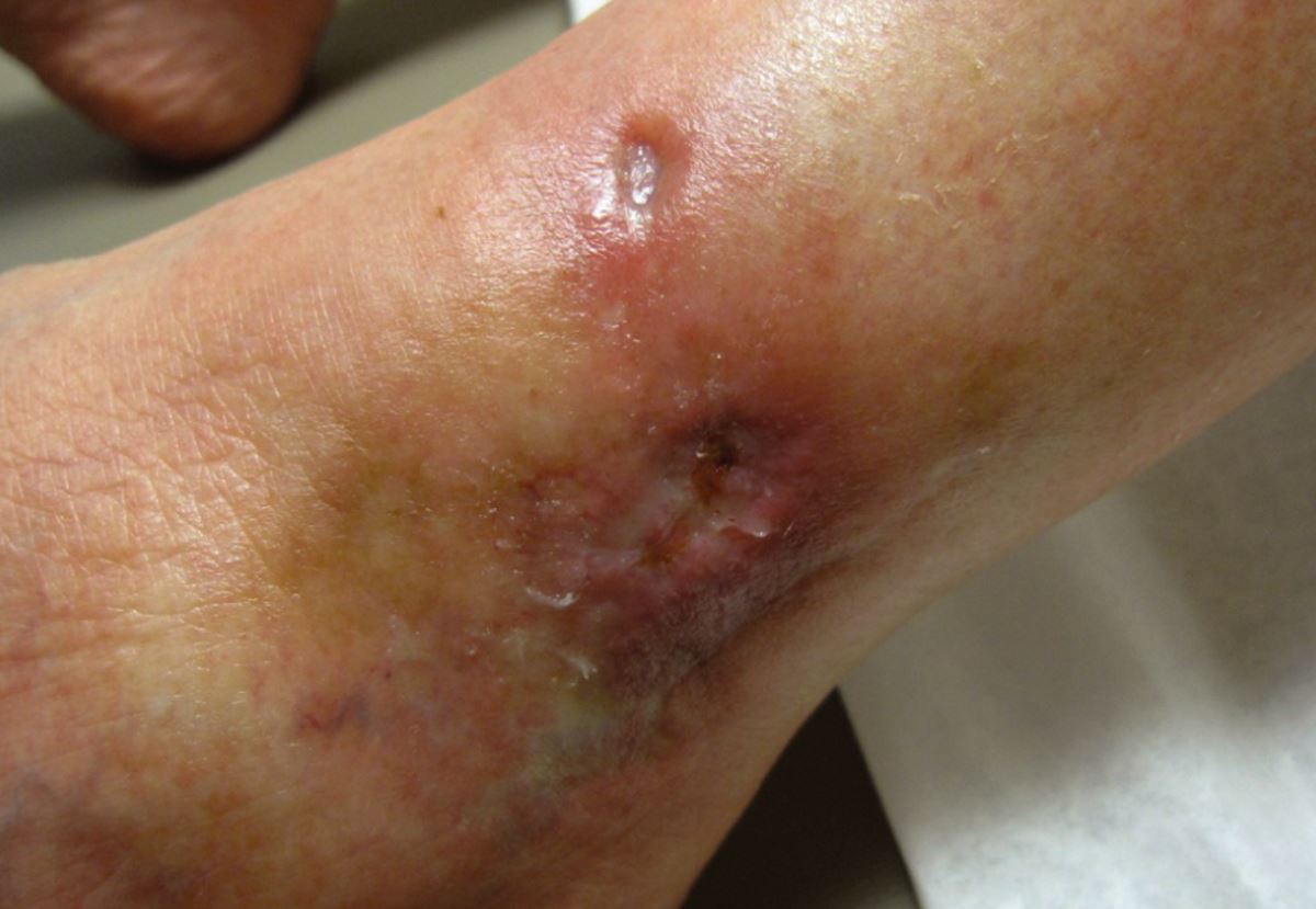 Ankle ulcers pictures