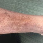 Symptoms of venous stasis dermatitis pictures