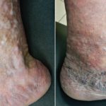 Varicose ulcers pictures