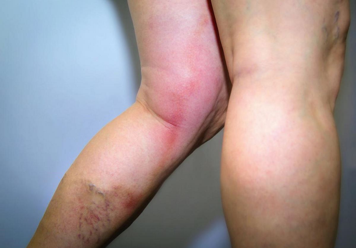 Vascular disease legs pictures