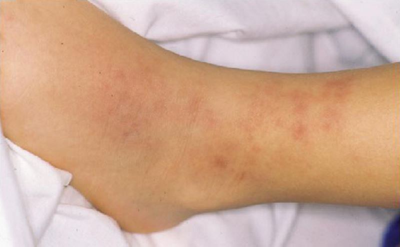 Vasculitic skin rash pictures