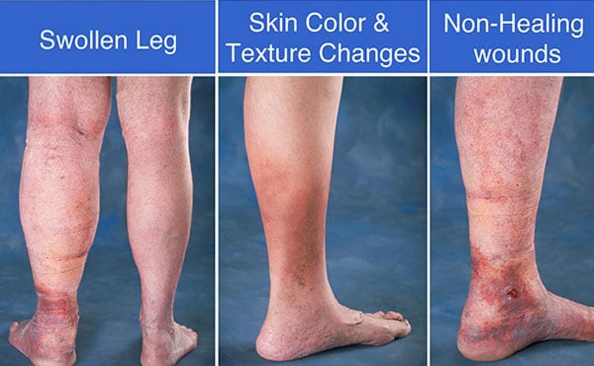 Venous Insufficiency Pictures Symptoms And Pictures