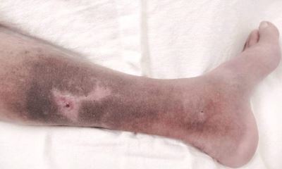 Venous skin ulcer pictures 2