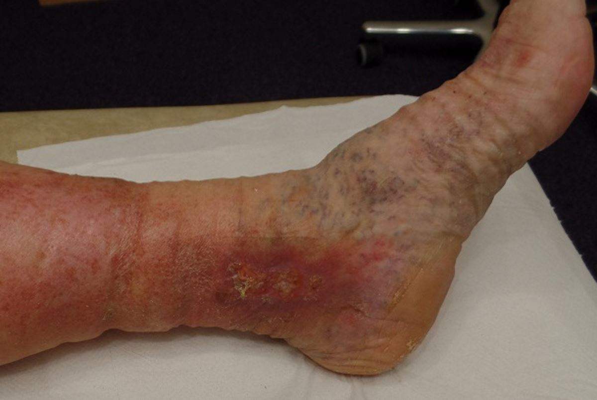 Venous stasis ulcer pictures