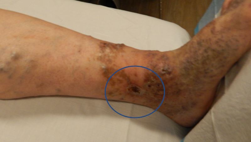 What does an ankle ulcer look like