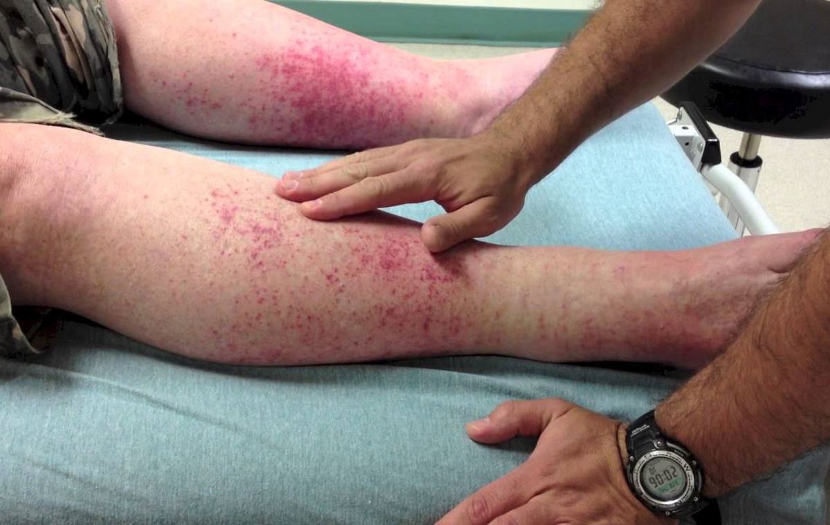What does vasculitis look like