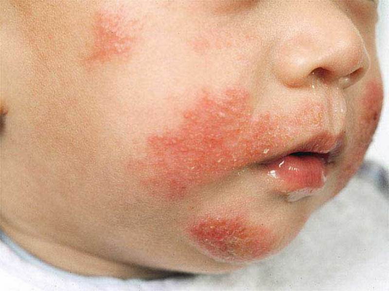Contact Dermatitis Baby Treatment Get More Anythinks