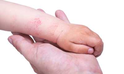 topical dermatitis pictures