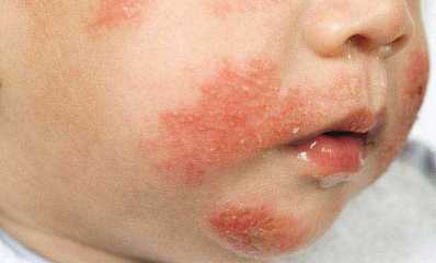 Atopic dermatitis in infants pictures