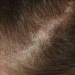 Seborrheic dermatitis pictures, scalp dermatitis pictures, seborrheic ...