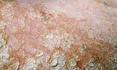 Fungal dermatitis pictures